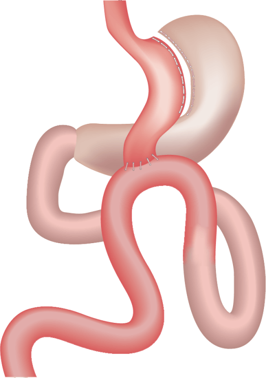 mini-gastric-bypass